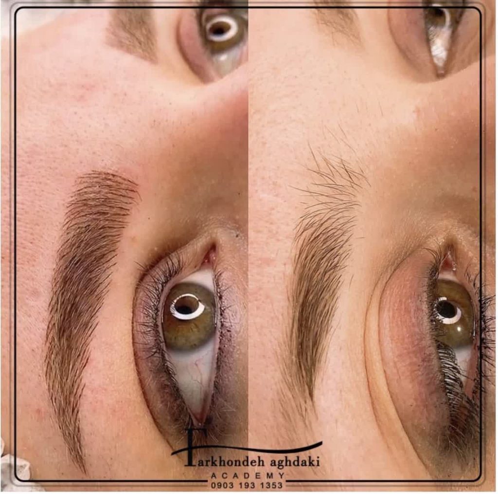  اجرای میکروبلیدینگ لیفت توسط فرخنده عقدکی