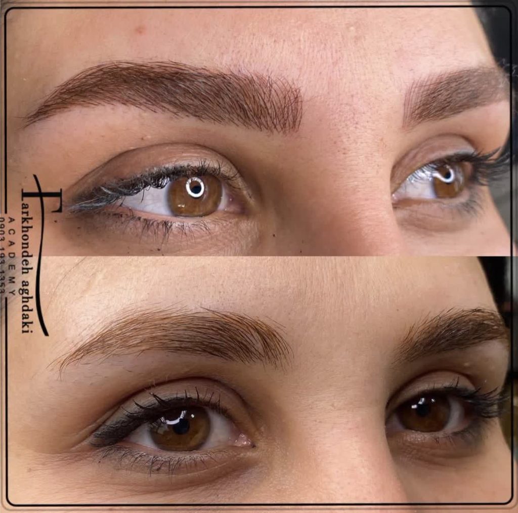 اجرای میکروبلیدینگ لیفت توسط فرخنده عقدکی