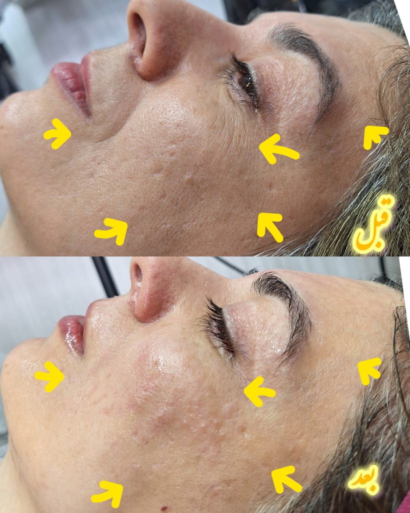 بهترین فیشیال