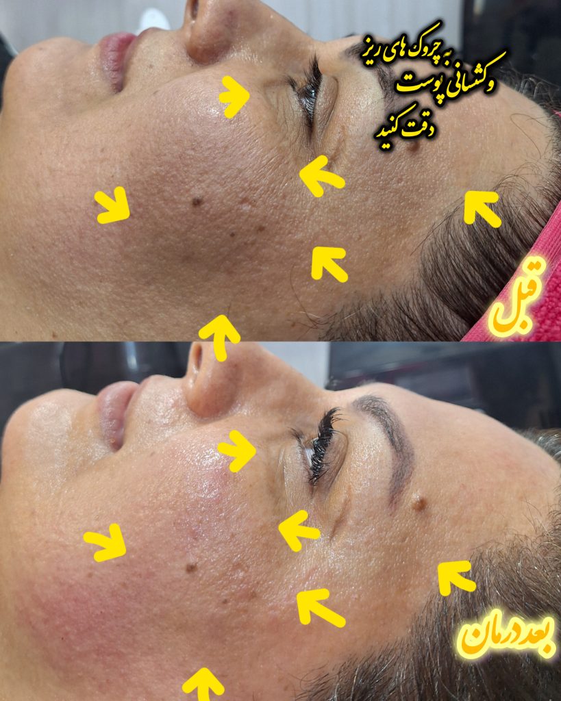 بهترین فیشیال اصفهان