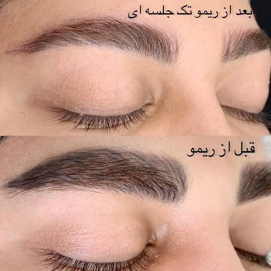 ریمو ابرو اصفهان