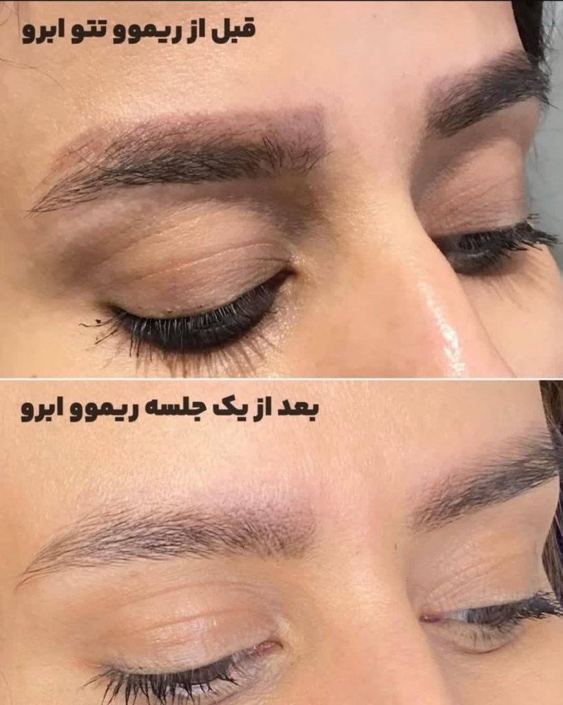 ریمو ابرو اصفهان